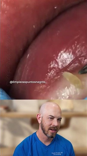 Close-Up Blackhead Removal and Skin Pressure