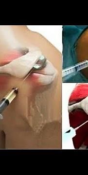 5 seconds trick to get pain free shoulder||Frozen shoulder||Intraarticular injection technique