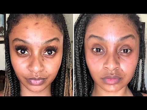 MICRONEEDLING RESULTS | 1 Week Post Microneedling on Black Skin | Day by Day vlog| MAURA BEAUTY