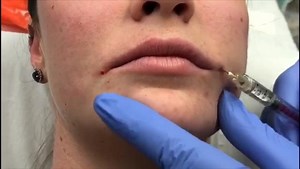 Lip filler with cannula and needle