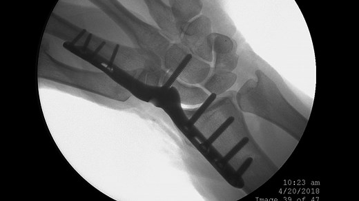 Total Wrist Fusion Using the Second Metacarpal Plate with Robert Bass, MD