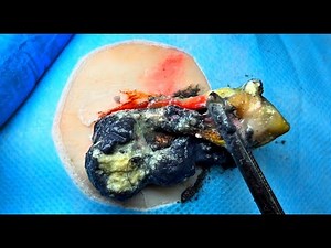 SACDEP SPA Cystic Acne // Pimple Removal // ACNE TREATMENT // Blackhead Removal 嚢胞性ざ瘡を取り除く A3Q2410