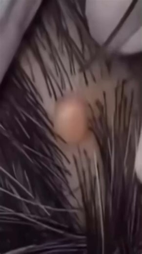 😱 You won't believe what came out of this one... #pimplepop #satisfying | Page 1