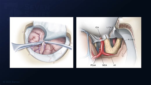 #358: Pterional Transsylvian Approach for Resection of a Medial Temporal Cavernous Malformation - All Videos - Seven Series Collection