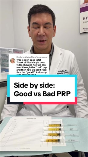 Replying to @VivianAlana Thanks for your comment! Here’s a video i made that shows bad and good PRP side by side. Remember over 99% of patients have good platelets, so if the PRP is BAD, it’s the way the PRP is made! #prptreatment #prp #sportsontiktok #doctorsoftiktok #prphairrestoration #stemcells