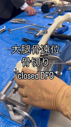 京都大学整形外科 kyoto university orthopaedic surgery on Instagram: "DFO: Distal Femoral Osteotomy"