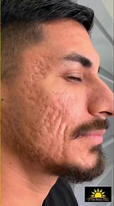 96 reactions · 11 comments | BEFORE & AFTER 1 SESSION OF ACNE SCAR...
