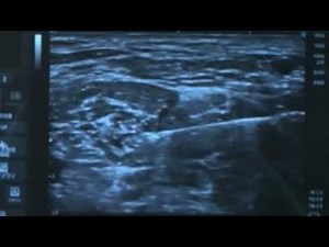 Ultrasound guided interscalene brachial plexus block 腕神経叢ブロック(斜角筋間アプローチ)