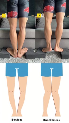 Want to reshape your legs? In this video, I’ll show you simple but powerful calf exercises you can do anywhere to achieve straighter, stronger and toned legs. These moves improves balance, stability, and walking power which are essential for daily life. Do each exercise 100 times everyday, and you’ll feel the difference in just a few weeks! #reels #explore #health #wellness #exercise #homeworkouts #knockknees #bowlegs #calf | Alex Libin