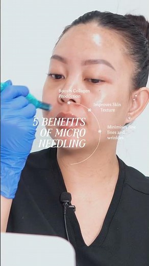 The benefits of microneedling