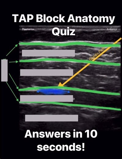 PNBschool - Anesthesia/Peripheral Nerve Blocks on Instagram: "A quick Friday review of TAP Block Anatomy. Share with someone who needs a little help😊 #regionalanesthesia #pnbschoolanesthesiablocks #anesthesia #anesthesiologistassistant #srna #crna #anesthesiologist #anestesiologia #anesthesiology #surgery"