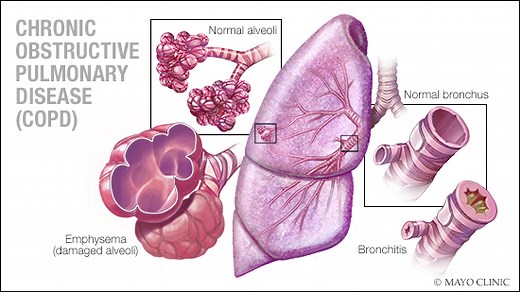 (VIDEO) When to consider a lung transplant: A Mayo Clinic expert explains - Mayo Clinic News Network