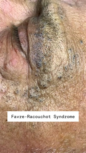 Dr. David Kim on Instagram: "Favre-Racouchot Syndrome aka solar comedone is due to extensive sun damage and causes cysts and large blackheads on the face and neck. It’s more common in men who smoke and is usually accompanied by other signs of extensive sun damage such as deep wrinkles! The good news is this is preventable w/ a solid skincare routine. Here are recommendations!👨🏻‍⚕️ #notsponsored ✅ Cleanser - If you have oily skin use a gentle cleanser morning and night to remove all the oil and