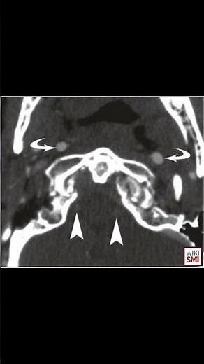 Blunt Cerebrovascular Injury Explained 🧠🚑 #neurology #trauma #meded #emergencymedicine #neurosurgery