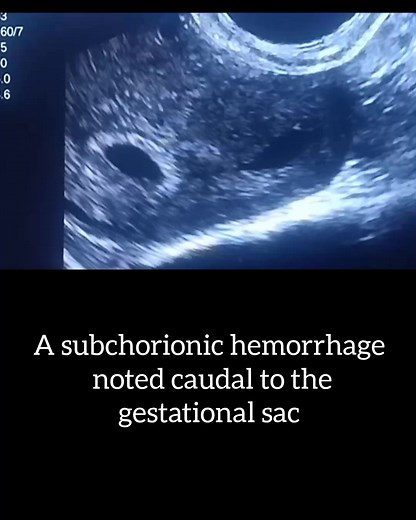 418 reactions · 41 shares | ♦️Subchorionic Hemorrhage #Radiology...