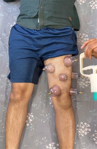 Knee Pain Relief in Minutes | Cupping Therapy