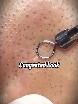 More than removes black heads again| Dr. Sandra Lee