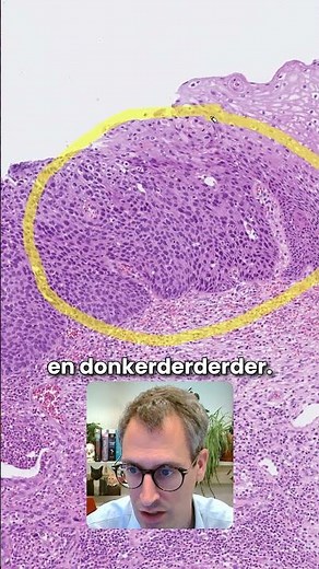 Baarmoederhalskanker #histologie #science#education #cancer #kanker #uitstrijkje #baarmoederhals