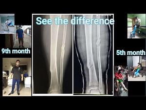 My TIBIA and FIBULA Full Healing Recovery Video