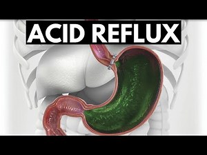 ACID REFLUX – EVERYTHING YOU NEED TO KNOW