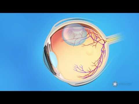 Elvin Ng’s eye surgery: Retinal detachment, myopia and the warning signs you should not ignore