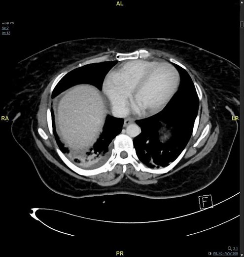 Abdominal CT scan showing perforated duodenum with pneumoperitoneum and free fluid