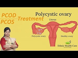 நீர் கட்டிக்கு சிகிச்சை முறைகள் | Treatment For PCOS / PCOD | Dr.B.Yoga Vidhya