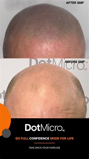 Transform Your Look with Scalp Micro Pigmentation
