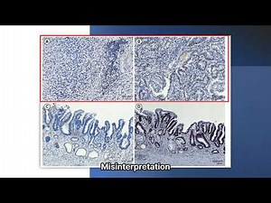 Mismatch Repair / Microsatellite Instability