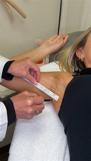 This is one of the most underrated areas we treat with Botox. Underarm Botox works by calming the sweat glands, helping reduce excessive sweating and keep you dry and comfortable for months at a time. It’s quick, effective, and can be life-changing for anyone who struggles with sweating through clothes, even when they’re not hot or active. No downtime. No daily stress. Just confidence that lasts. Curious if underarm Botox in La Jolla is right for you? Call (858) 250-0964 to book your consultatio