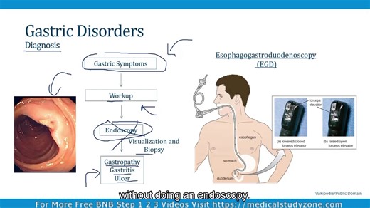 [胃肠病学|胃部疾病与消化性溃疡]-[Gastroenterology|Gastric Disorders]-(BNB Step2/3|072)