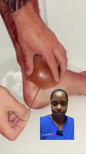 Doctor reacts to large burn blister pop! . . #burnblister #waterblister #largeblister #blisterpop #popaholics #doctorreacts #doctor #medstudent #nursestudent #healthtip