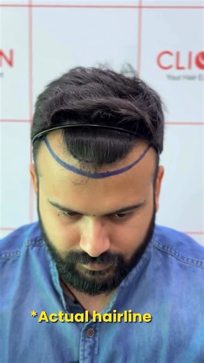 Clion Hair Transplant on Instagram: "@rjnishit 4 months of visible growth!✨ #hairtransplant #hairtransplantprogress #4monthshairtransplant #rjnishit #hairgrowthjourney #clioncare #hairtransplantresults #beforeafterhairtransplant #naturalhairgrowth #gujarathairclinic (hair transplant, hair transplant progress, 4 months hair transplant, rj nishit hair transplant, hair growth journey, clion care, hair transplant results, before after hair transplant, natural hair growth, gujarat hair clinic)"