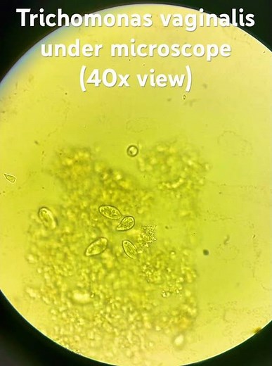 Trichomonas under microscope (40xview) #Pathology