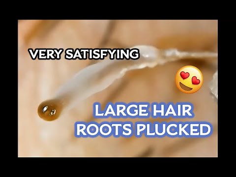 Squishy's #1 Ingrown Hair Root Removal (Microscopic)