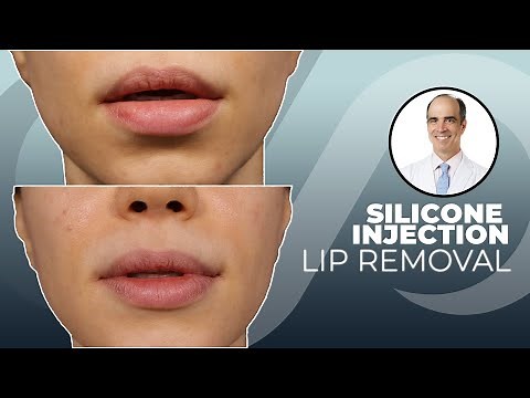 Remove Silicone Lip Injections Safely - Dr. David Stoker