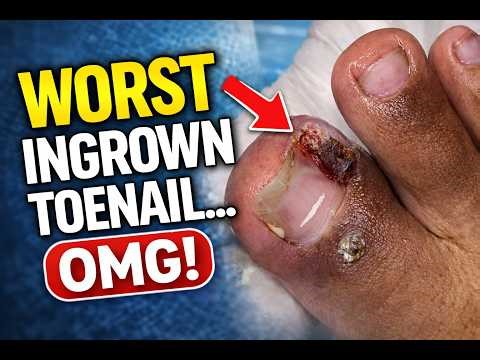 Severe Ingrown Toenail Removal with Large Granulation Tissue