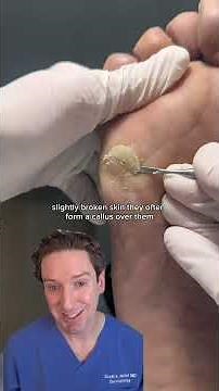 How to tall if you have a callus or wart! #callus #wart #oddlysatisfying #wartscrape
