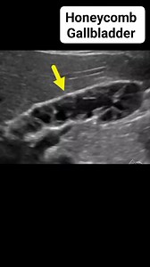 3.6K reactions · 422 shares | Honeycomb gallbladder on ultrasound #radiology #medical #radiologist #ultrasound #signsinradiology #gallbladder | Radiology Interesting Cases | Facebook