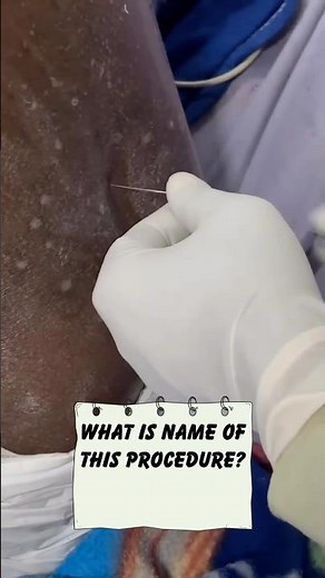 Lumber Puncture || #MedEd || #Medicaltok || #Diagnosis || #Rear_cases ||