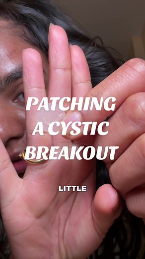 Effective Methods for Cystic Acne Treatment