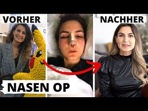 MY NOSE SURGERY ➠ BEFORE AND AFTER PICTURES, PAIN, COSTS, PROCEDURE | TBATB