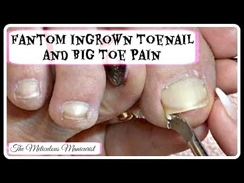 Ingrown Toenail Big Toe Pain Remedy Pedicure Tutorial