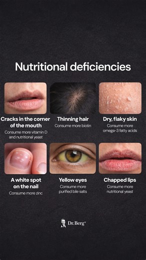 Dr. Berg on Instagram: "Many symptoms people ignore are actually signs of nutrient deficiencies. The majority of the population is low in key nutrients like vitamin D, magnesium, zinc, B vitamins, and potassium. Over 50% of people consume ultra-processed foods that provide calories but little to no nutrition. Many foods today are grown with a limited mineral profile, far below what the body actually requires. Cracks in the corners of the mouth are commonly linked to B vitamin deficiencies, espec
