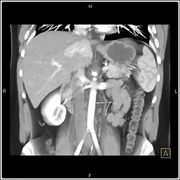 Abdomen: Liver: A series of axial and 3D views show a mass in the left lobe of the liver(1 of 2)