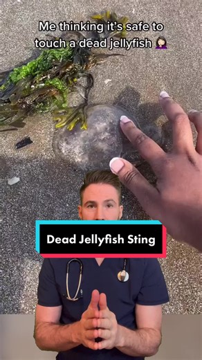 Dead jellyfish can still sting! #jellyfish #beachlife #seacreature #wildlife #steveirwin