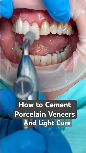 How to Cement Porcelain Veneers ...Step by Step 💕