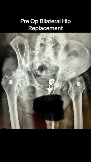 First Walk in 3 Months After Double Hip Replacement 💥🦿 | Life-Changing Moment