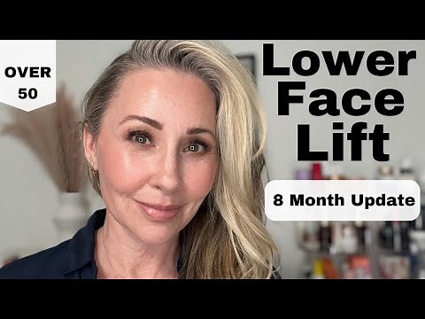 Lower Face Lift: 8 Month Update