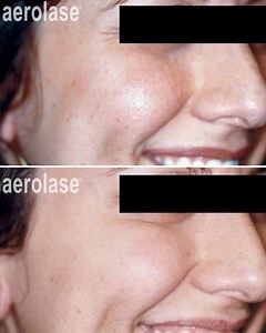 Get ready! EraPeel season is arriving fast 💨 Tis' the season for ablative laser therapy using the Aerolase Era Elite® Correct your sun damage, reverse signs of aging, and reduce pigmentation in a single treatment this fall and winter. Our Era Elite® is the technology of choice for rejuvenating the face, neck, chest, hands, or other area of the body. Our laser rejuvenates aging skin in just a single treatment by gently vaporizing and replenishing the skin’s outer layers in a precisely controlled